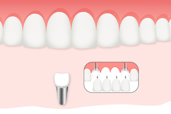 种植牙的利与弊