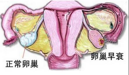 卵巢早衰治疗后还能恢复卵巢功能吗？