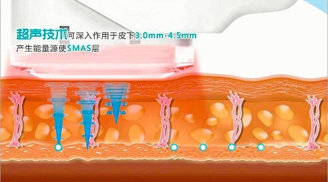 超声刀适合多大年龄做？超声刀效果怎么样多久见效果？