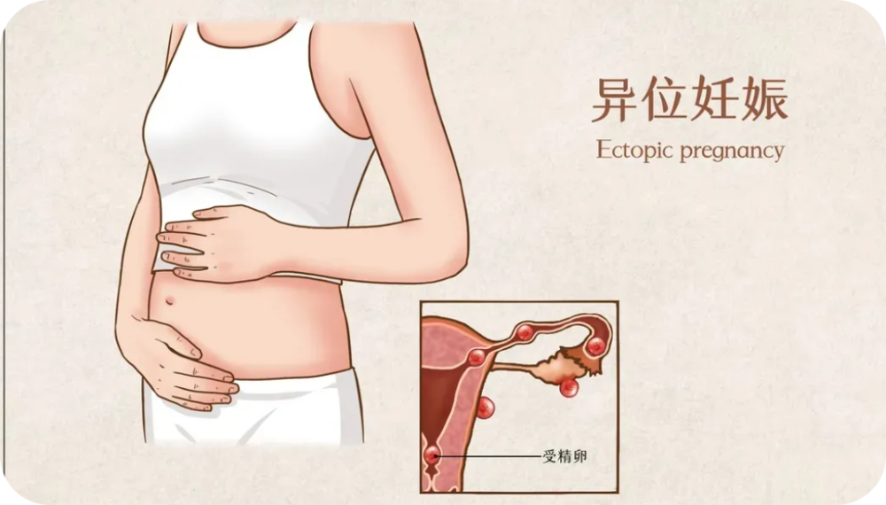 宫外孕能用验孕棒测出来吗 答案还不明显吗