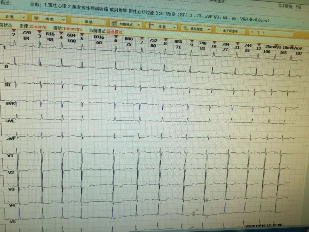 心悸是怎么回事？